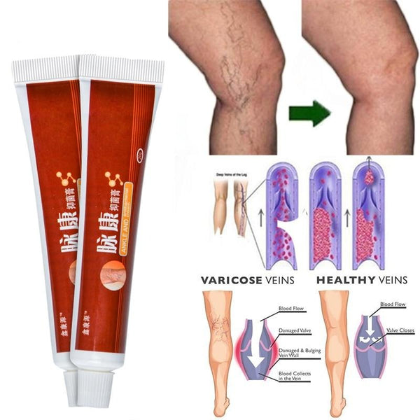 Varicose Veins Miracle Cream (Original Product)